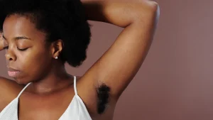 Woman with visible dark underarm discoloration